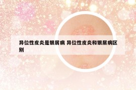 異位性皮炎是銀屑病 異位性皮炎和銀屑病區(qū)別