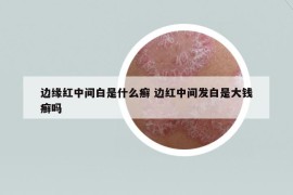 邊緣紅中間白是什么癬 邊紅中間發(fā)白是大錢癬嗎