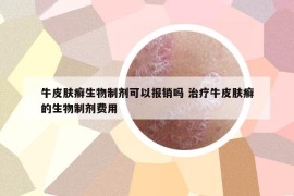 牛皮膚癬生物制劑可以報(bào)銷嗎 治療牛皮膚癬的生物制劑費(fèi)用