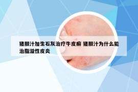 豬膽汁加生石灰治療牛皮癬 豬膽汁為什么能治脂溢性皮炎