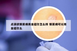 點滴狀銀屑病用金紐爾怎么樣 銀屑病可以用金紐爾么