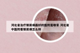 河北省治療銀屑病最好的醫(yī)院是哪家 河北省中醫(yī)院看銀屑病怎么樣