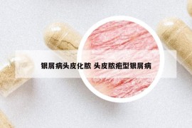 銀屑病頭皮化膿 頭皮膿皰型銀屑病