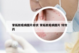 掌跖膿皰病圖片癥狀 掌跖膿皰病圖片 特效藥