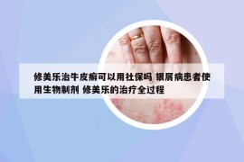 修美樂治牛皮癬可以用社保嗎 銀屑病患者使用生物制劑 修美樂的治療全過程