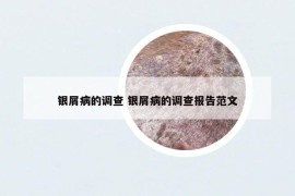 銀屑病的調(diào)查 銀屑病的調(diào)查報(bào)告范文