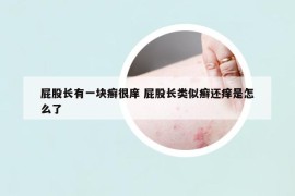 屁股長有一塊癬很庠 屁股長類似癬還癢是怎么了