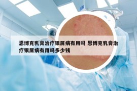 恩博克乳膏治療銀屑病有用嗎 恩博克乳膏治療銀屑病有用嗎多少錢