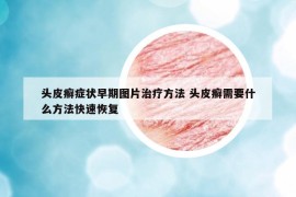 頭皮癬癥狀早期圖片治療方法 頭皮癬需要什么方法快速恢復