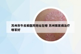 蘇州市牛皮癬醫(yī)院地址在哪 蘇州銀屑病治療哪家好