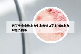 兩歲半寶寶臉上有牛皮癬似 2歲小孩臉上有癬怎么回事
