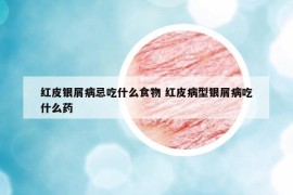 紅皮銀屑病忌吃什么食物 紅皮病型銀屑病吃什么藥