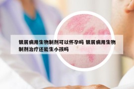 銀屑病用生物制劑可以懷孕嗎 銀屑病用生物制劑治療還能生小孩嗎