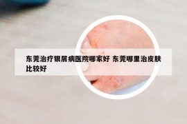 東莞治療銀屑病醫(yī)院哪家好 東莞哪里治皮膚比較好