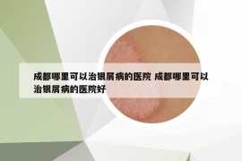 成都哪里可以治銀屑病的醫(yī)院 成都哪里可以治銀屑病的醫(yī)院好