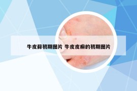 牛皮蘚初期圖片 牛皮皮癬的初期圖片