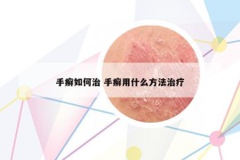 手癬如何治 手癬用什么方法治療
