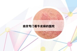 南京專門看牛皮癬的醫(yī)院