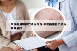 牛皮癬用哪種方法治療好 牛皮癬用什么藥治效果最好