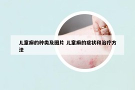 兒童癬的種類及圖片 兒童癬的癥狀和治療方法