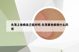 頭發(fā)上有癬自己能好嗎 頭發(fā)里有癬用什么藥膏
