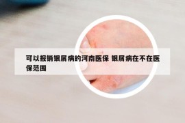 可以報(bào)銷銀屑病的河南醫(yī)保 銀屑病在不在醫(yī)保范圍