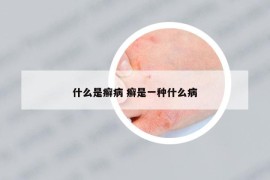 什么是癬病 癬是一種什么病
