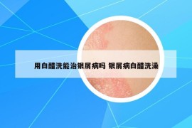 用白醋洗能治銀屑病嗎 銀屑病白醋洗澡