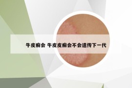 牛皮癬會 牛皮皮癬會不會遺傳下一代