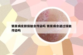 銀屑病皮膚接觸會(huì)傳染嗎 銀屑病會(huì)通過(guò)接觸傳染嗎