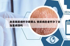 身患銀屑病懷孕敢要么 銀屑病患者懷孕了會(huì)加重病情嗎
