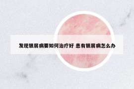 發(fā)現(xiàn)銀屑病要如何治療好 患有銀屑病怎么辦