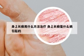 身上長(zhǎng)癬用什么方法治療 身上長(zhǎng)癬是什么病引起的