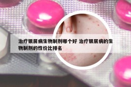 治療銀屑病生物制劑哪個(gè)好 治療銀屑病的生物制劑的性價(jià)比排名