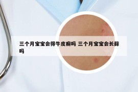 三個月寶寶會得牛皮癬嗎 三個月寶寶會長蘚嗎