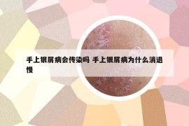 手上銀屑病會傳染嗎 手上銀屑病為什么消退慢