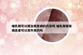 哺乳期可以摸治銀屑病的藥膏嗎 哺乳期銀屑病患者可以用外用藥嗎