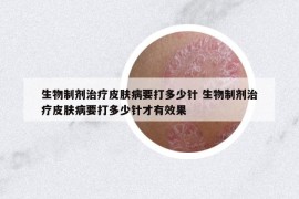 生物制劑治療皮膚病要打多少針 生物制劑治療皮膚病要打多少針才有效果