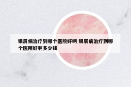 銀屑病治療到哪個醫(yī)院好啊 銀屑病治療到哪個醫(yī)院好啊多少錢