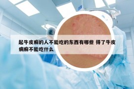起牛皮癬的人不能吃的東西有哪些 得了牛皮病癬不能吃什么