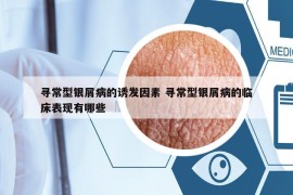 尋常型銀屑病的誘發(fā)因素 尋常型銀屑病的臨床表現(xiàn)有哪些