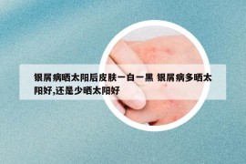 銀屑病曬太陽后皮膚一白一黑 銀屑病多曬太陽好,還是少曬太陽好