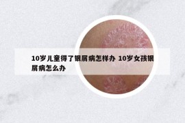 10歲兒童得了銀屑病怎樣辦 10歲女孩銀屑病怎么辦