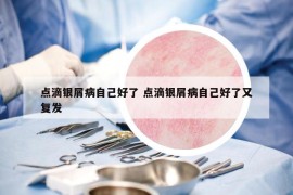 點(diǎn)滴銀屑病自己好了 點(diǎn)滴銀屑病自己好了又復(fù)發(fā)