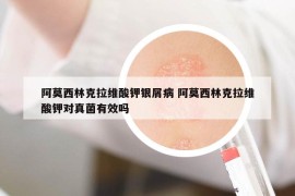 阿莫西林克拉維酸鉀銀屑病 阿莫西林克拉維酸鉀對真菌有效嗎