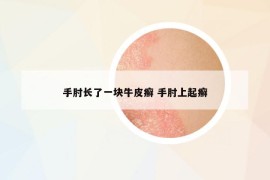 手肘長(zhǎng)了一塊牛皮癬 手肘上起癬