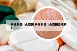 頭皮癬是什么原因 頭皮癬是什么原因造成的?