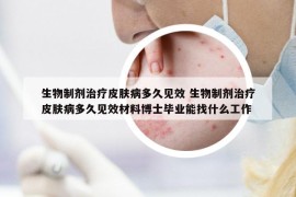 生物制劑治療皮膚病多久見效 生物制劑治療皮膚病多久見效材料博士畢業(yè)能找什么工作
