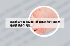 銀屑病關(guān)節(jié)炎有沒有打修美樂治愈的 銀屑病打修美樂多久見效