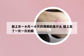 腿上長(zhǎng)一小片一小片的像癬的是什么 腿上出了一片一片的癬